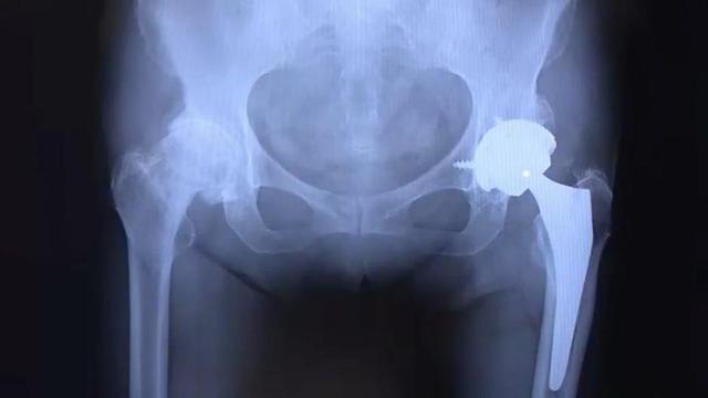 すり減った関節のレントゲン.jpg